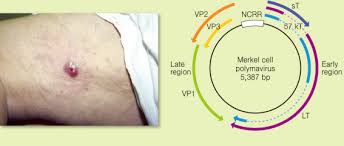 The process also helps doctors determine how to best treat mcc, and the risk of it coming back. Merkel Cell Polyomavirus An Overview Sciencedirect Topics