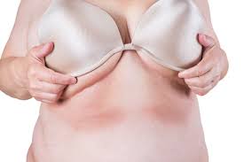 Image result for Intertrigo under breasts