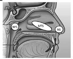 Swelling and irritation of the nasal cavities (rhinitis) or sinus cavities (rhinosinusitis) also can further narrow the nasal passage from a deviated septum, resulting in nasal obstruction. Http Ldh La Gov Assets Oph Coronavirus Resources Providers Swabfactsheet Pdf