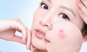 Tại sao dùng sữa rửa mặt lại nổi mụn? Tìm hiểu nguyên nhân