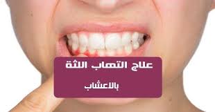 علاج التهاب اللثة بالأعشاب التهاب اللثة مشكلة يعاني منها الكثير من الناس حتى عند غسل اسنانك بالفرشاة او تناول الطعام ترى ان اللثة تنزف بكثرة فهذا دليل على اصاب
