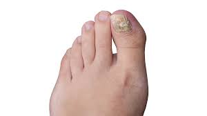 Your toenail is turning black because the fungus has gone untreated for many months or the treatment that you were using didn't work. 11 Tips To Avoid Toenail Fungus Easy To Catch Hard To Kill Whyy