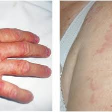 İnsanlar zonaya genellikle bir kere yakalanır. Pdf Disseminated Granuloma Annulare 3 Clinical Cases Granulom Inelar Diseminat 3 Cazuri Clinice