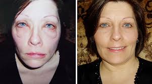 Included is detail on natural alternatives. Delayed Allergic Reactions To Omalizumab Are Patients Reporting All Cases Journal Of Allergy And Clinical Immunology