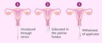 Iud is a method of contraception which is easily reversible, which means that if you want it can be removed and your fertility returns to normal. How Does The Iud Work And What Are The Pros Cons