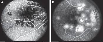 The pathophysiology of apmppe is still inconclusive owing to a lack of histopathological evidence of acute disease activity. Acute Posterior Multifocal Placoid Pigment Epitheliopathy Apmppe Sciencedirect