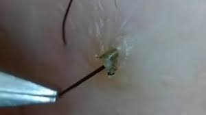 Soak a washcloth in warm water and press it against the ingrown hair (s) for several minutes. The Best Ingrown Hair Removal Videos