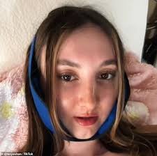 I was bullied for looking like a squirrel so I underwent $200k surgery to  change my jaw