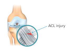 In a grade 1 sprain, the ligaments of the ac joint stretch or partially tear, but the bones don't separate. Acl Injury Symptoms Treatment And Recovery