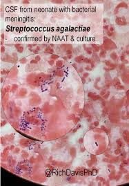 Image result for CSF Gram Stain