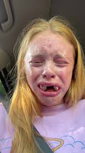 Why Getting Wisdom Teeth Removed Can Get You In TROUBLE! 😳🦷 #wisdomteeth  #mouth #dentist