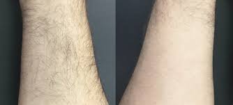 Electrology has been proven effective and has been the only permanent choice for hair removal in over 125 years. Laser Hair Removal Montreal Men S Aesthetics Medispa Physimed