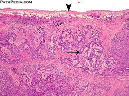 Berg kb, dacic s, miller c, cheung s, churg a. Histopathology Images Of Malignant Mesothelioma By Pathpedia Com Pathology E Atlas