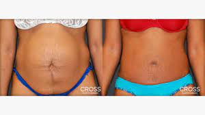 With advanced surgical techniques, your body contour can be refined, reshaped, and enhanced. Tummy Tucks And The Belly Button What Happens To It