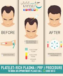 Platelet Rich Plasma Prp Procedure To Book An Appointment Please Call 3365 5913 P R P حقن البلازما لحجز موعد Platelet Rich Plasma Prp Procedure Platelets