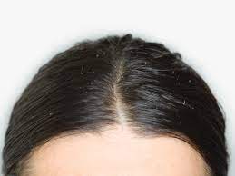 The best treatments for hair loss out there are finasteride and minoxidil, often sold under the name brand rogaine. Hair Scalp Pain When You Do Not Wash It Why Does Hair Hurt When It S Dirty