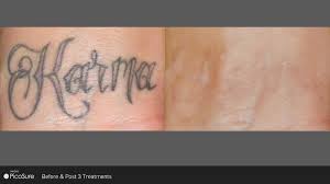 The removal timeline can be broken down into the following way: Oak Park Laser Tattoo Removal