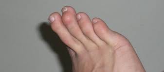 Image result for Hammer toe