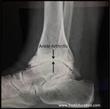 Image result for Ankle XRay