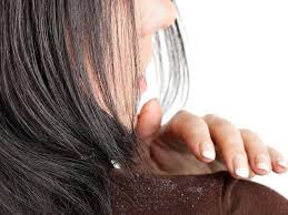 We have a combination of 4b natural hair and 4c natural hair. How To Use Onion Juice For Dandruff Removal Simple Diys