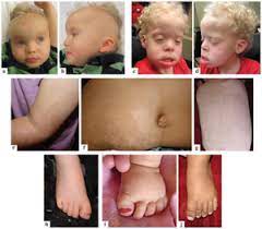 Eye diseases, fetal diseases, neuronal diseases, rare malacards based summary : Pallister Killian Mosaic Syndrome Physiopedia