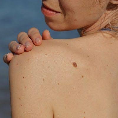 Mole Removal in Islamabad, Rawalpindi &amp;amp; Pakistan