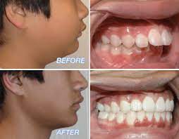 According to webmd, crooked teeth, overbites and underbites are usually inherited traits; Overjet Overbite In Adult Teeth Causes Orthodontic Treatments
