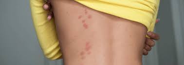 Image result for scabies bite