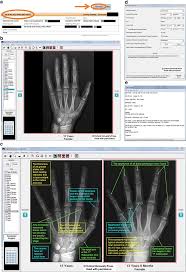 Skeletal Development Of The Hand And Wrist Digital Bone Age