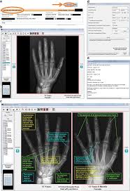 skeletal development of the hand and wrist digital bone age