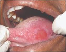 Image result for lichen planus on tongue)