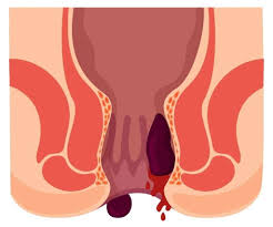 Image result for hemorrhoids