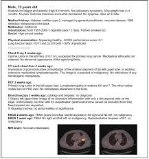 Profound fatigue is very common in the late stages of lung cancer. Variation Between Multidisciplinary Tumor Boards In Clinical Staging And Treatment Recommendations For Patients With Locally Advanced Non Small Cell Lung Cancer Chest
