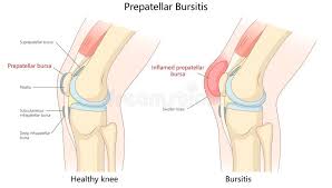 Image result for Prepatellar Bursitis
