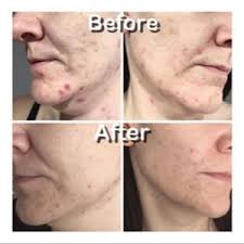 glycolic peels