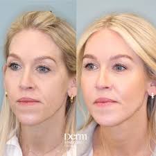 Treatments for aging eyes: From skin care products to lasers to surgery, Dr  Roth discusses it all. Dr Roth loves SkinCeutical's Retinol, B5 Gel and AOX  Eye. For stronger results, he recommends