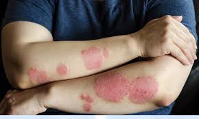 Image result for contact dermatitis