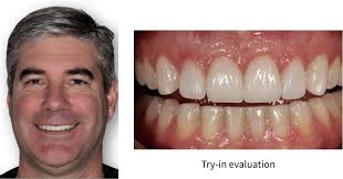 Image result for Occlusal