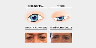 Les fans de chirurgie plastique apprendront comment refaire un nez. Traitement Chirurgical Du Ptosis A Paris Centre Ophtalmologique Coss