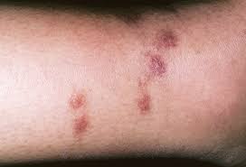 Your doctor will ask what your main symptoms are, when they began. Spider Bites Pictures To Identify Spiders And Their Bites