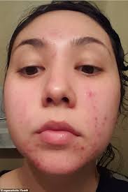 Has vitamin c, electrolytes & other nutrients. Woman Shares Incredible Transformation Photos Using Trader Joe S Skincare Daily Mail Online