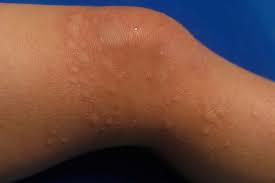 Image result for allergy rash on the legs