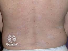 Image result for Diffuse Hyperpigmentation