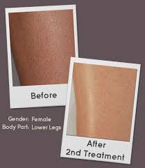 The best hair removal machines. Remington I Light Pro Intense Pulsed Light Hair Removal System Silver Refurbished Ipl6000usa