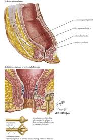 Image result for Ischiorectal Abscess