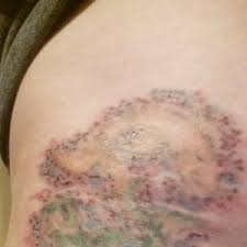 The full laser tattoo removal procedure explained. Red Dots After Tattoo Removal Any Suggestions Photos
