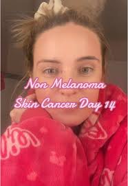 Basal Cell Carcinoma Near Eye