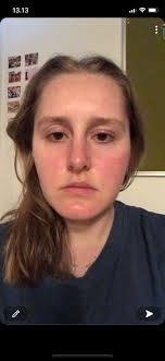 Does anyone else get a rash