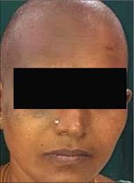 Image result for Diffuse Hyperpigmentation