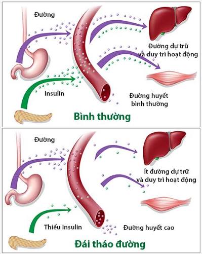 Rối loạn sản xuất hoặc sử dụng insulin có thể khiến glucose tăng cao trong máu